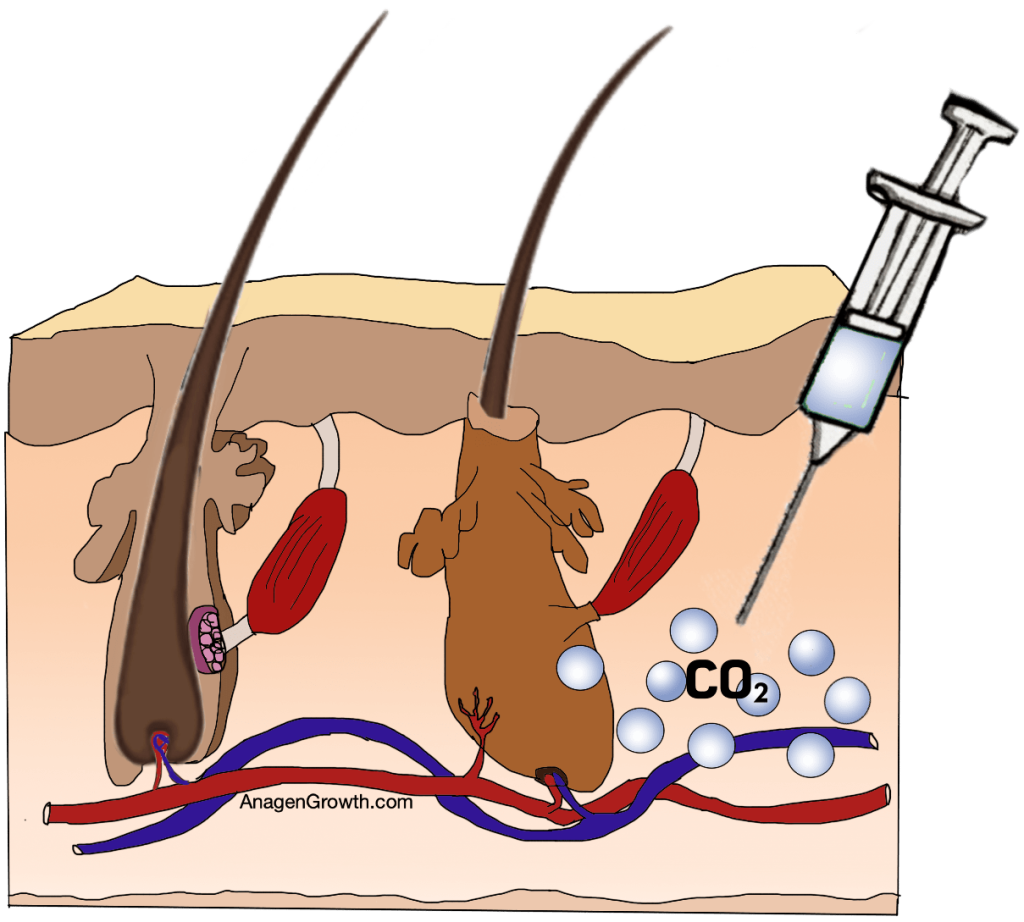Carboxytherapy for hair loss. CO2 injection into the skin.