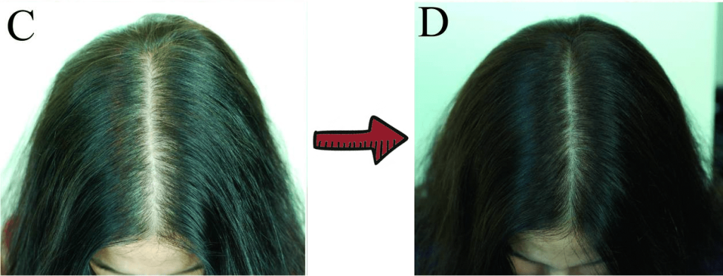 hair growth before and after picture of green tea extract trial