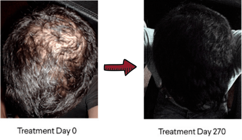 hair growth before and after picture of EGCG trial
