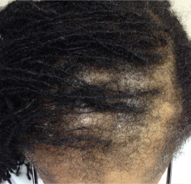 traction alopecia